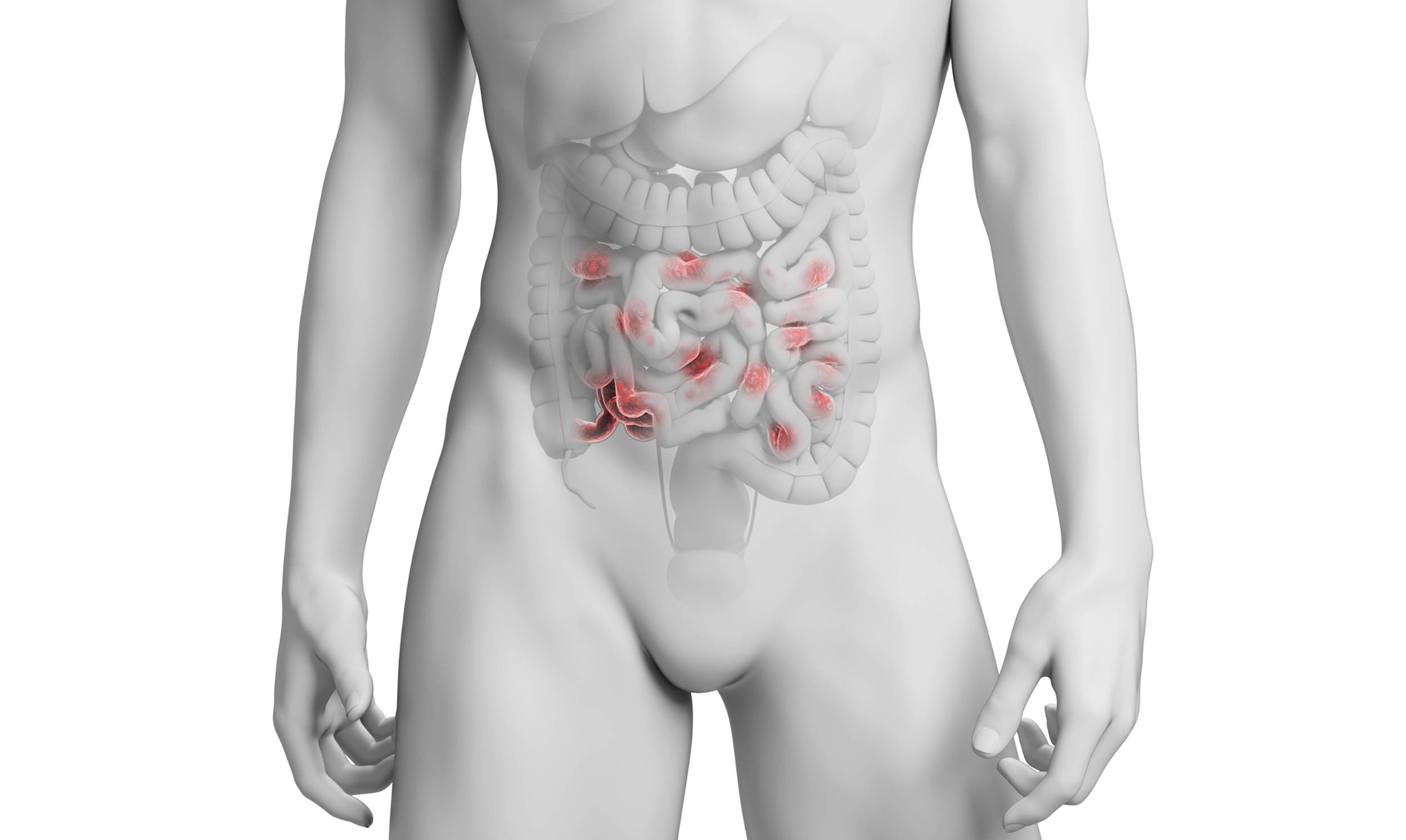 Inflammatory Bowel Disease